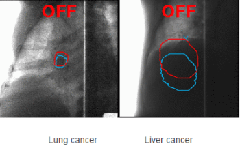 Toshiba and QST Develop Novel Heavy-Ion Radiotherapy Technology to Accurately Track Tumor Motion